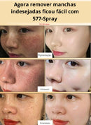 Spray- 577 Remove manchas de SOL, IDADE E MELASMA! 50% DE DESCONTO + FRETE GRÁTIS!