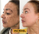 Facial Mask- Remove manchas de Idade, Sol e Melasma! Para mãos e Rosto! FRETE GRÁTIS