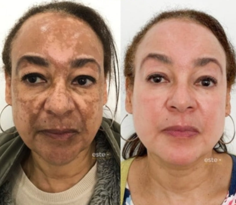 Spray- 577 Remove manchas de SOL, IDADE E MELASMA! 50% DE DESCONTO + FRETE GRÁTIS!