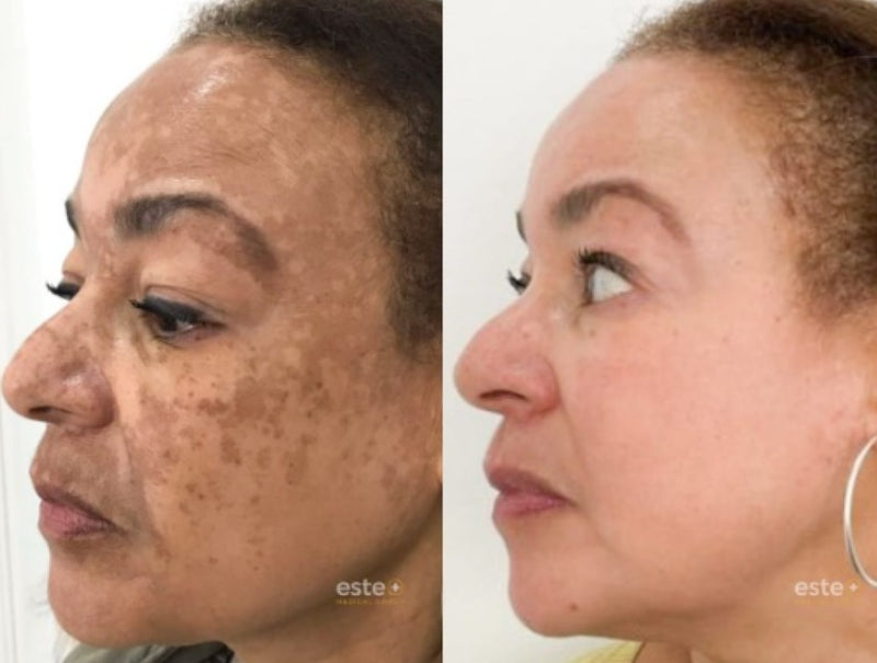 Spray- 577 Remove manchas de SOL, IDADE E MELASMA! 50% DE DESCONTO + FRETE GRÁTIS!