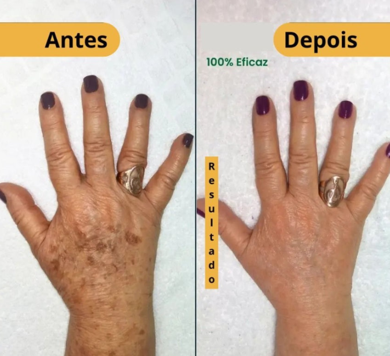 Spray- 577 Remove manchas de SOL, IDADE E MELASMA! ULTIMAS UNIDADES - 60% DE DESCONTO + FRETE GRÁTIS!