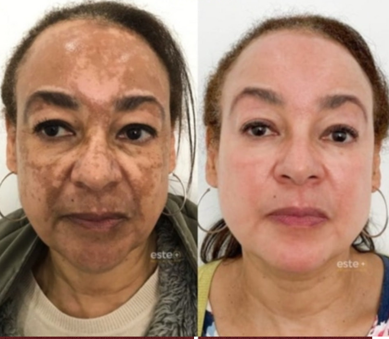 Spray- 577 Remove manchas de SOL, IDADE E MELASMA! ULTIMAS UNIDADES - 60% DE DESCONTO + FRETE GRÁTIS!